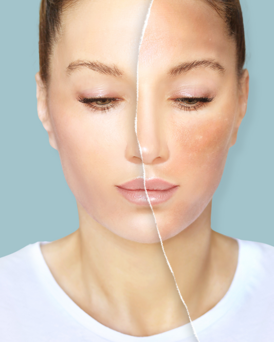 Manchas-en-la-piel-melasma-mejora-la-textura