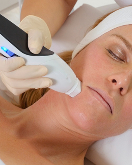 Radiofrecuencia Fraccionada