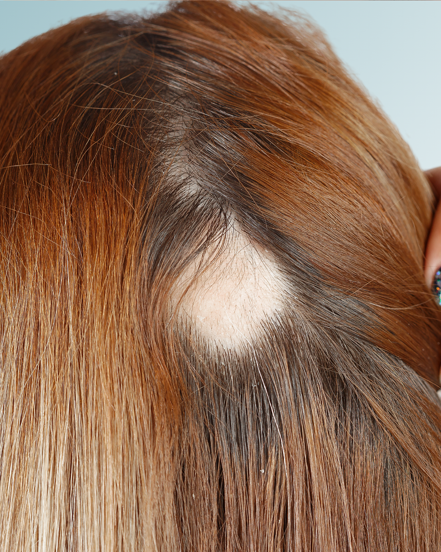 Alopecia-perdida-de-cabello-tratamiento
