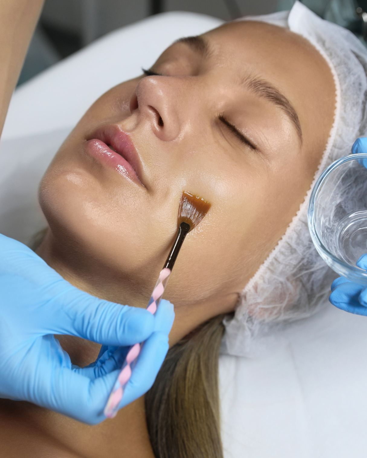 Peeling-quimico-rostro-cuello-cuerpo