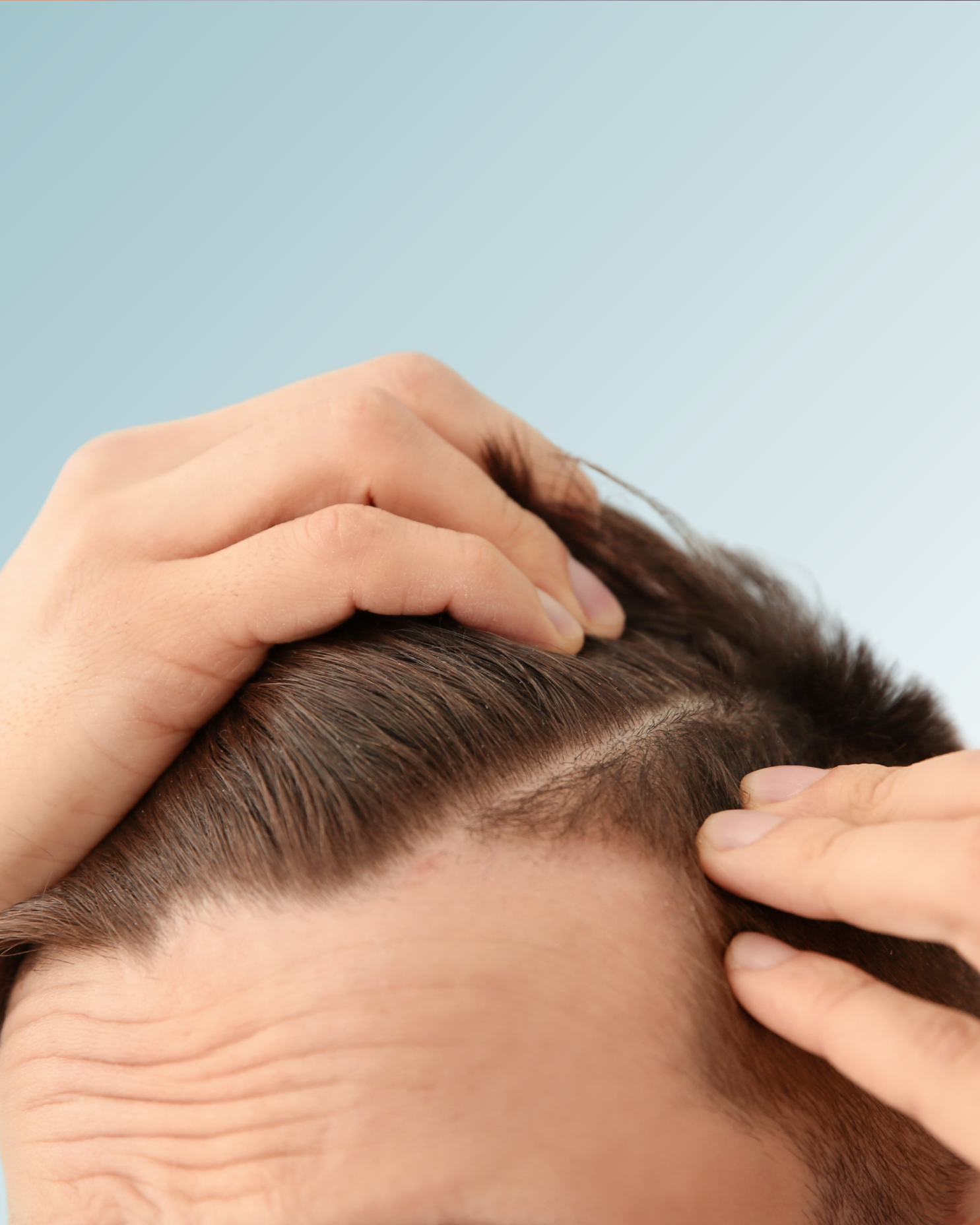 Perdida-de-cabello-alopecia