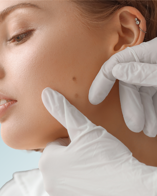 eliminacion-de-lunares-y-verrugas